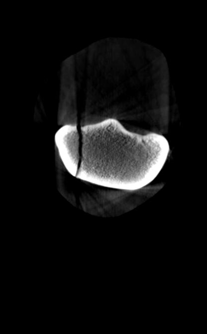 incomplete-condylar-fracture-trans
